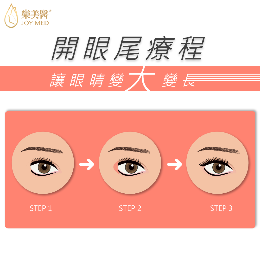開眼尾可以改善眼尾角度、弧度及長度，令雙眼比例更加和諧，配合開眼頭成效更佳