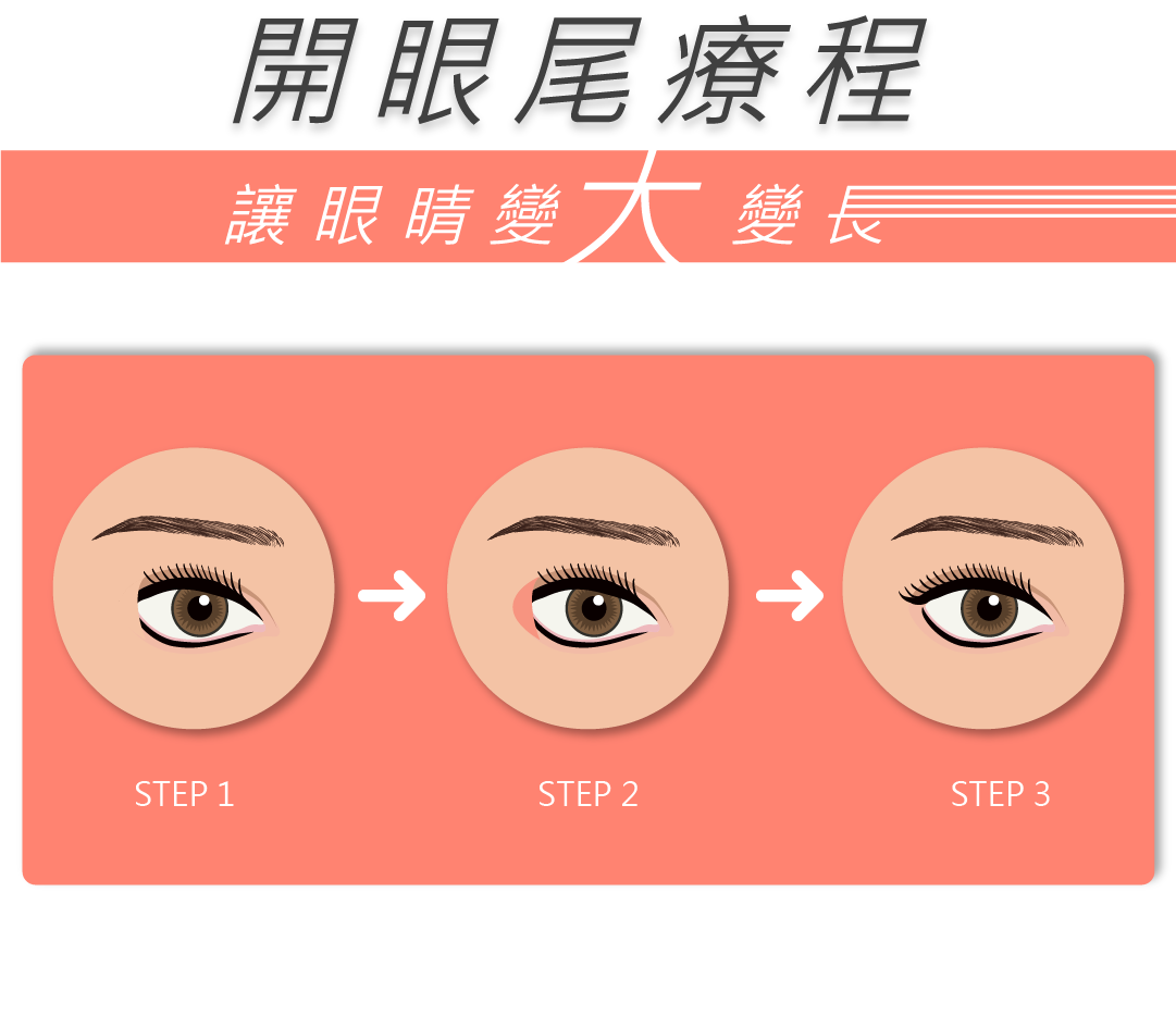 開眼尾可以改善眼尾角度、弧度及長度，令雙眼比例更加和諧，配合開眼頭成效更佳