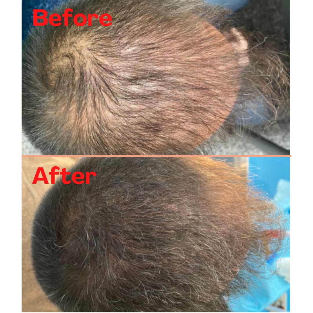 RGA幹細胞活髮療程助客戶在5個月內，解決脫髮及頭髮稀疏煩惱。