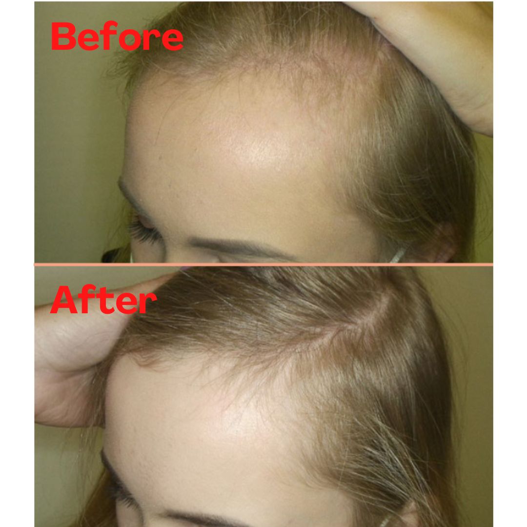 RGA幹細胞活髮有效針對各種脫髮類型，髮線後移情況也能在6個月能得到顯著改善。