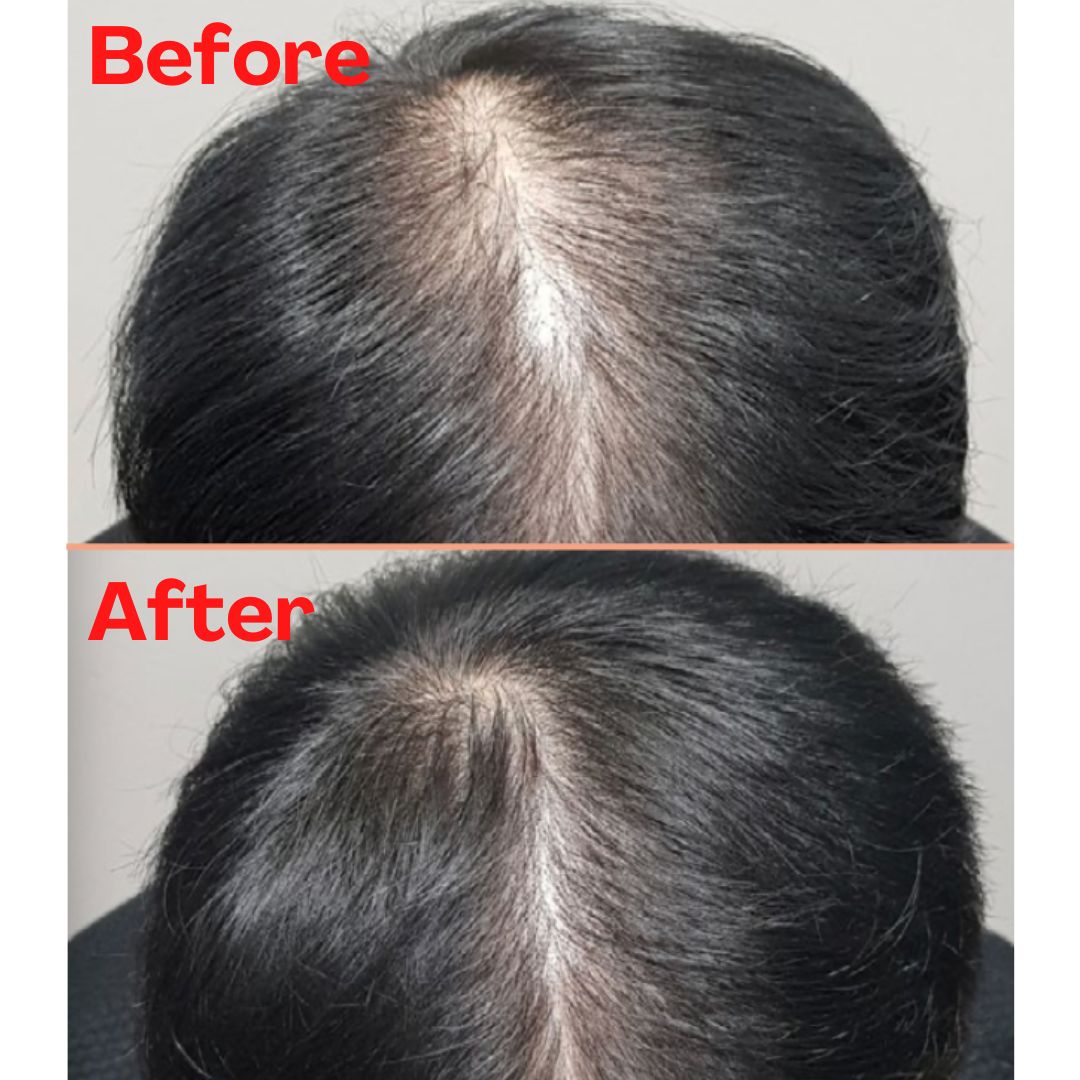 客戶接受RGA生髮療程後3個月效果，脫髮位置的髮量明顯增加。