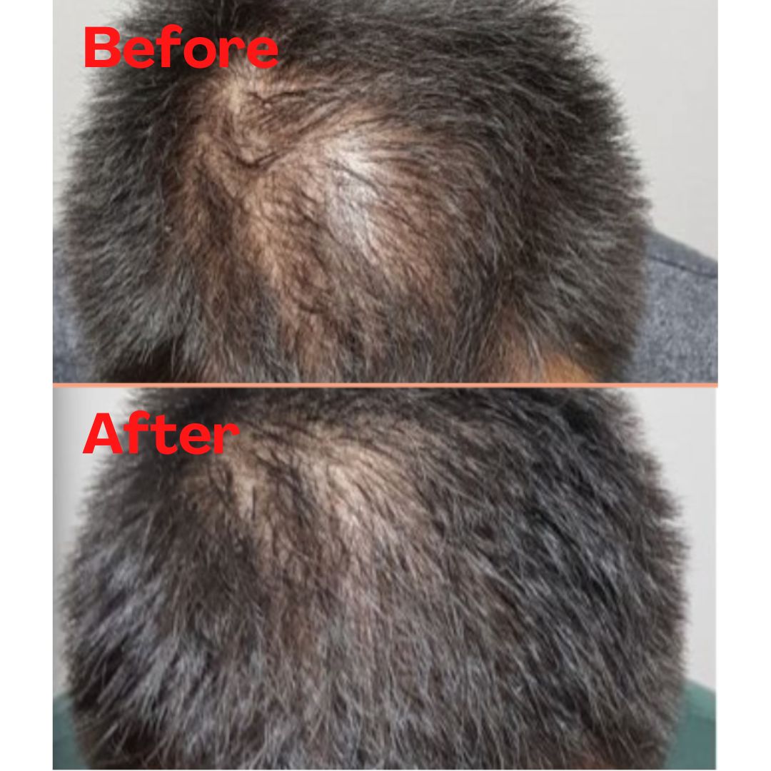 客戶進行RGA醫學活髮後1個月內，脫髮情況迅速等到改善。