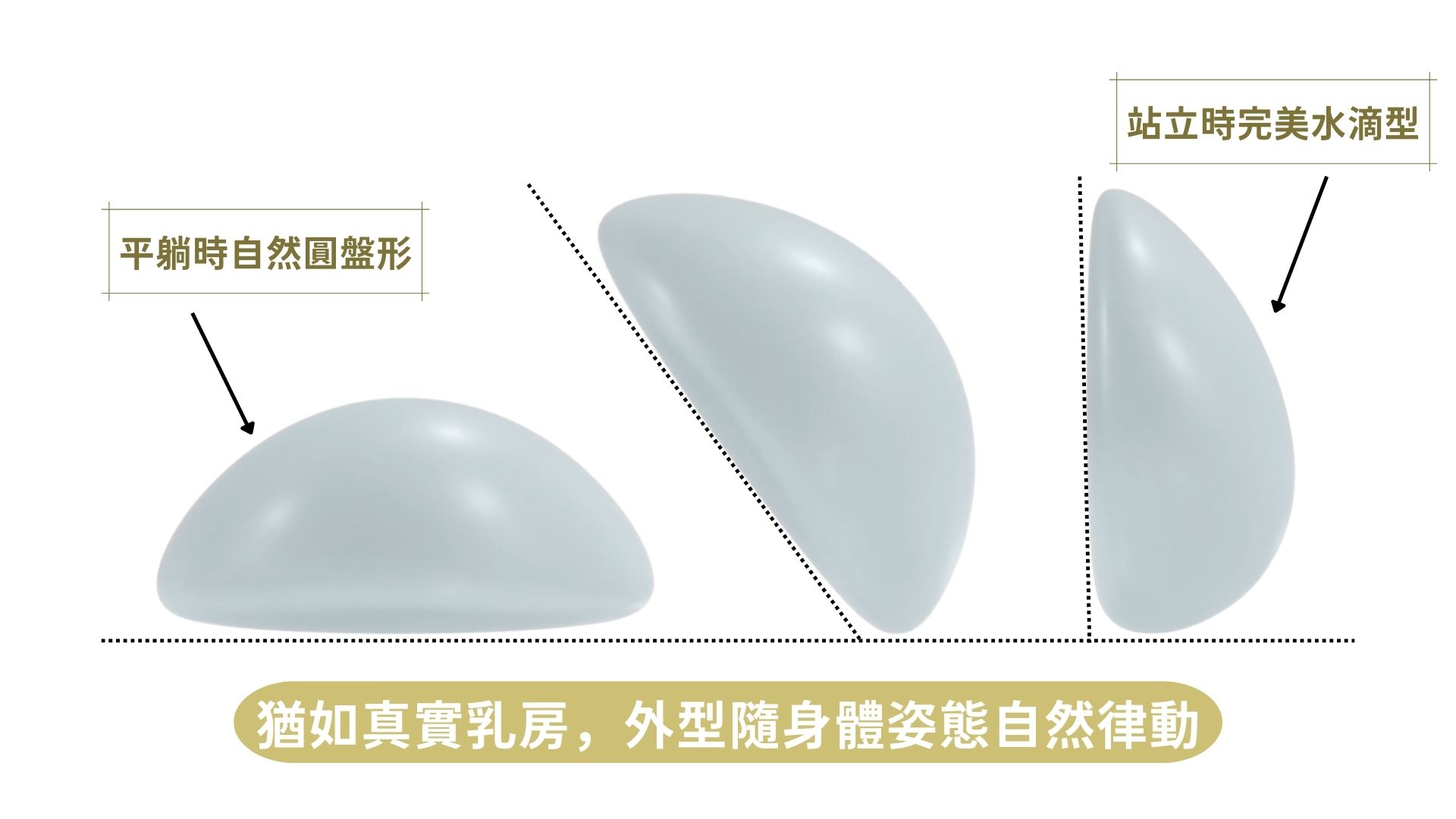 JoyMed香港提供Motiva隆胸療程，採用Motiva魔滴胸原廠正貨，假體擁有高度流動性及100%填充的特點，外觀非常自然。