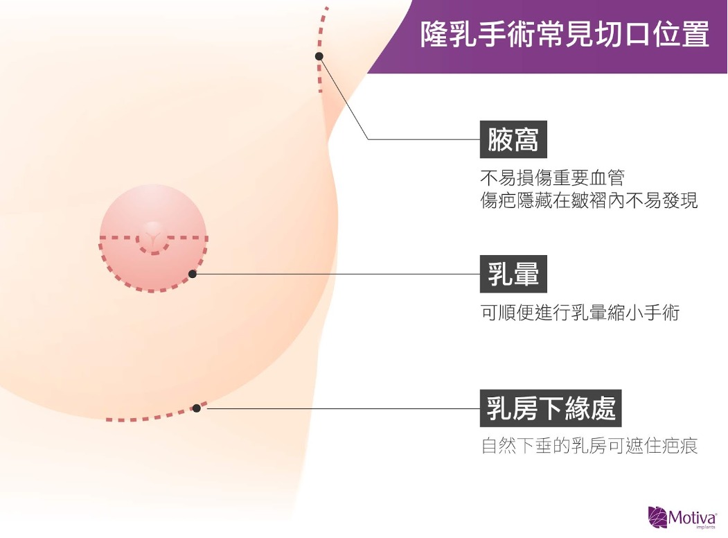 Motiva魔滴胸可以選擇不同的切口，包括腋窩、乳暈、乳房下緣處